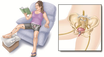 Posterior Tibial Nerve Stimulation (PTNS)