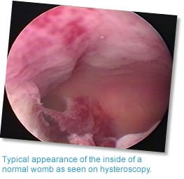 Typical appearance of the inside of a normal womb as seen on hysteroscopy.