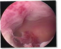 Pre Ablation