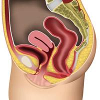 Small cystocele