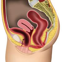 Significant cystocele