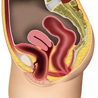 Severe cystocele