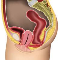 Significant uterine prolapse
