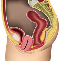 Severe uterine prolapse