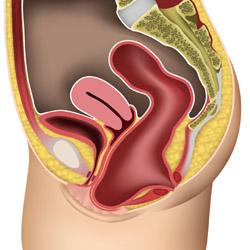 Severe rectocele