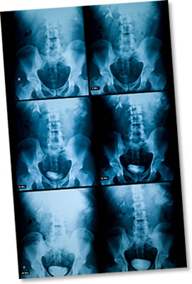 Xray of kidney and bladder